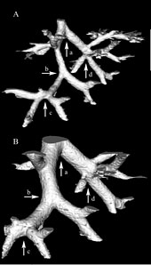 }3 Three-dimensional structures of same branching network at (A) FRC and (B) TLC. Diameter range at FRC: 300 ~ 170 mm. Airway generation Z range: 10 ~ 16. The arrows (a ~ d) indicated the same dividers in (A) and (B). 